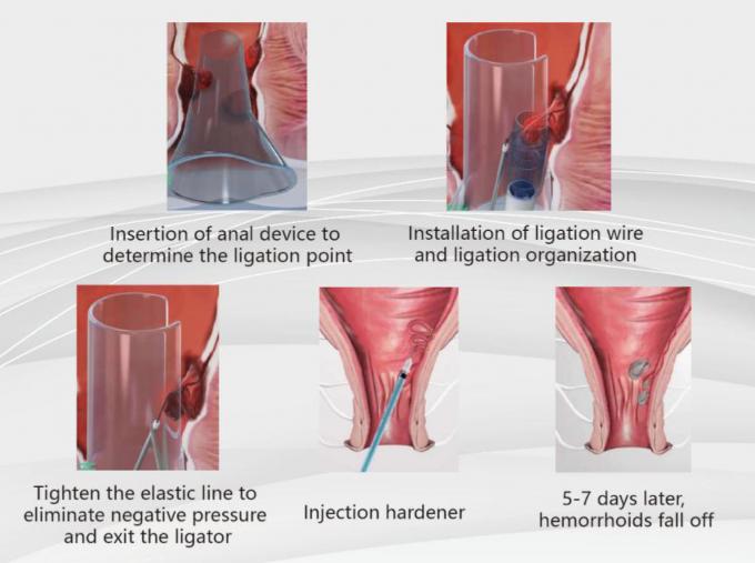 Automation Anorectal Ligator Hemorrhoid Stapler Elbow Type 3
